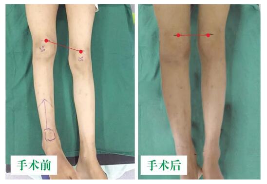 女孩墜梯右腿縮短5cm，幸得醫(yī)生及時診治恢復正常腿型