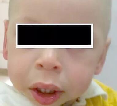 williams-Beuren綜合征——所謂的罕見(jiàn)病可能就在你身邊