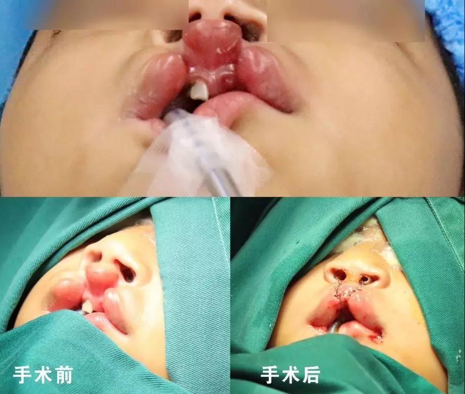 唇腭裂盡早治療消除孩子自卑心理，快樂成長！