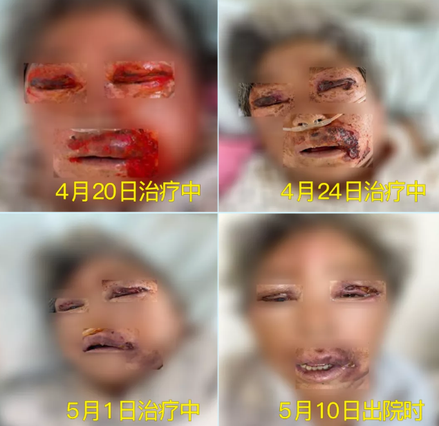 膿毒血癥（急性頜面部蜂窩組織炎）多學(xué)科聯(lián)合會診，幫助患者成功治愈！