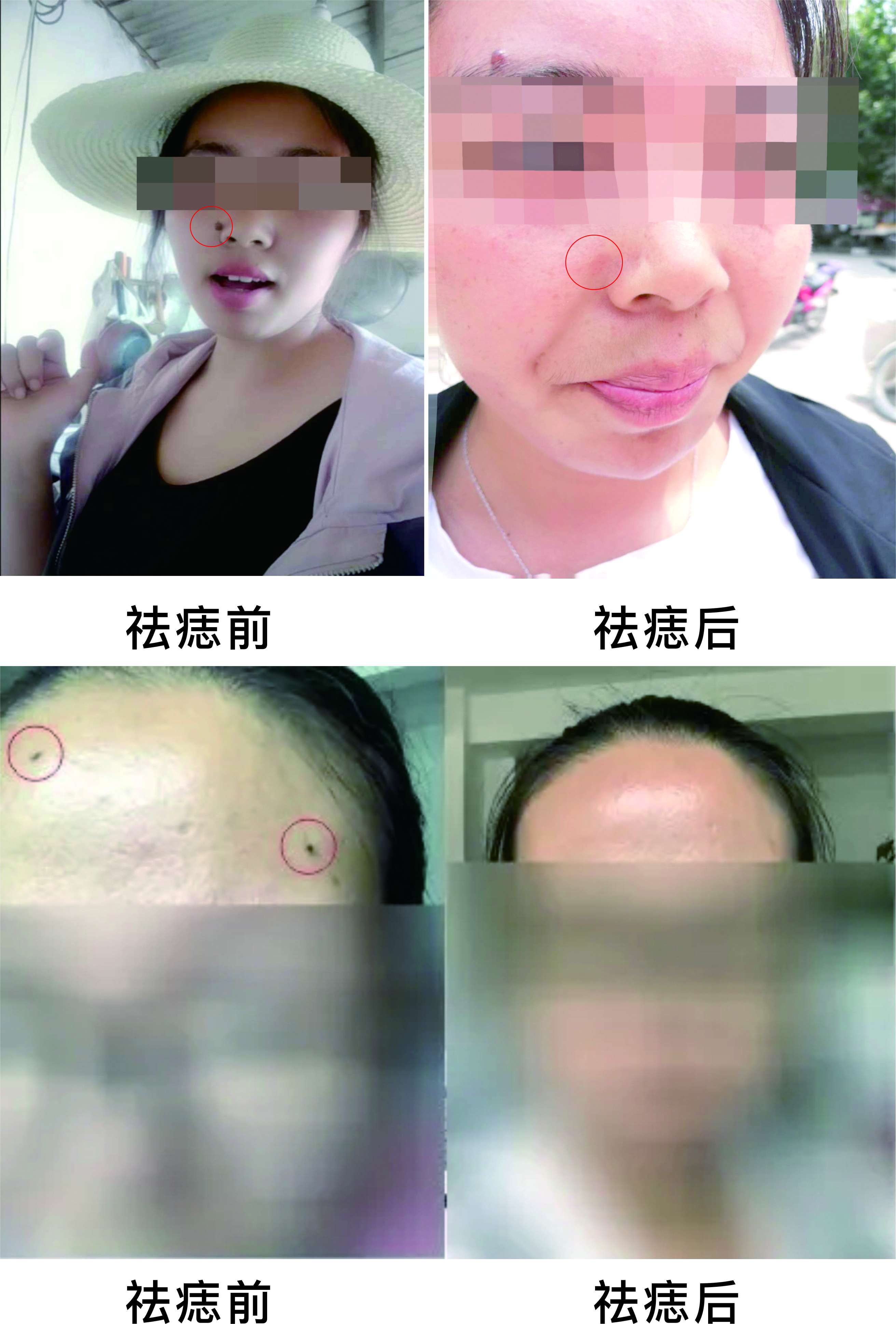 微波祛痣，告別臉部多余的“點(diǎn)綴”~
