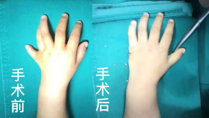 【保山安利醫(yī)院】2歲小兒手、足多指（趾）成功修復(fù)(矯正）！