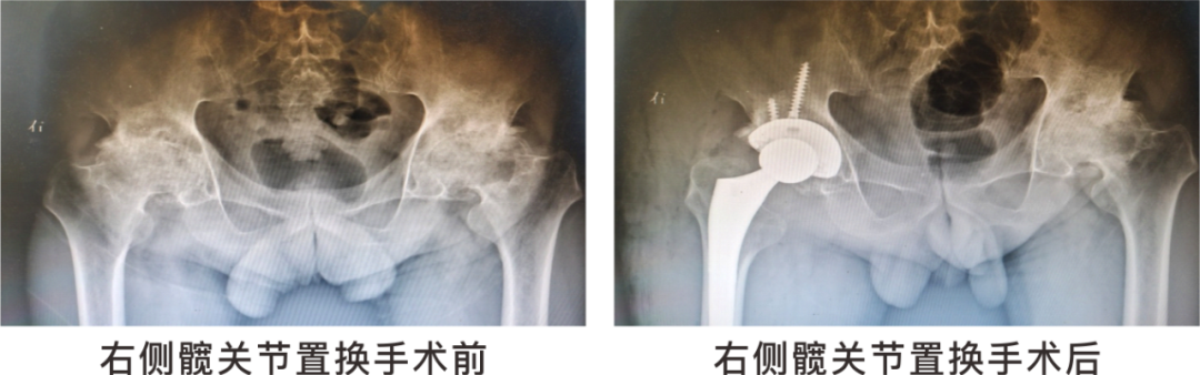 【保山安利醫(yī)院】長期飲酒導致雙側股骨頭壞死，髖關節(jié)置換后重獲運動功能！