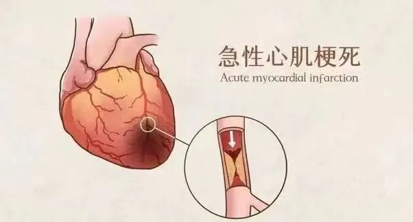 【保山安利醫(yī)院】11月20日“心梗救治日” 時間就是心肌，時間就是生命！