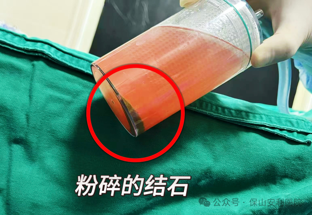 科普丨泌尿結(jié)石“克星”鈥激光碎石術(shù)，手術(shù)動(dòng)圖揭秘全過程！